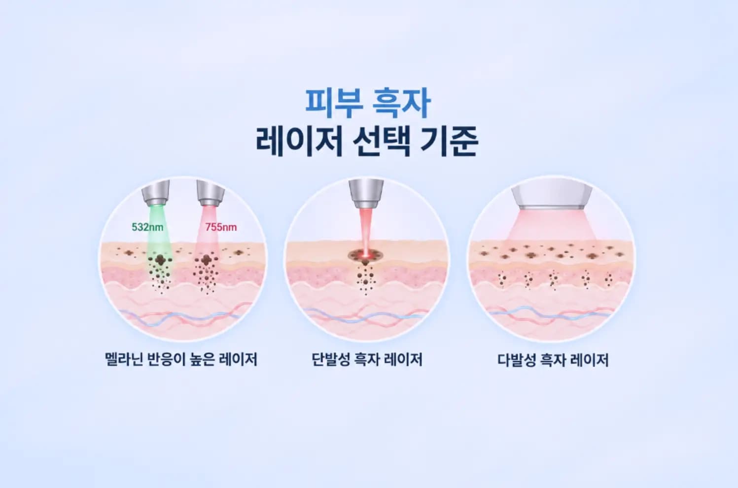 피부 흑자의 색소 깊이와 레이저 파장별 침투 범위를 세 단면으로 비교한 썸네일