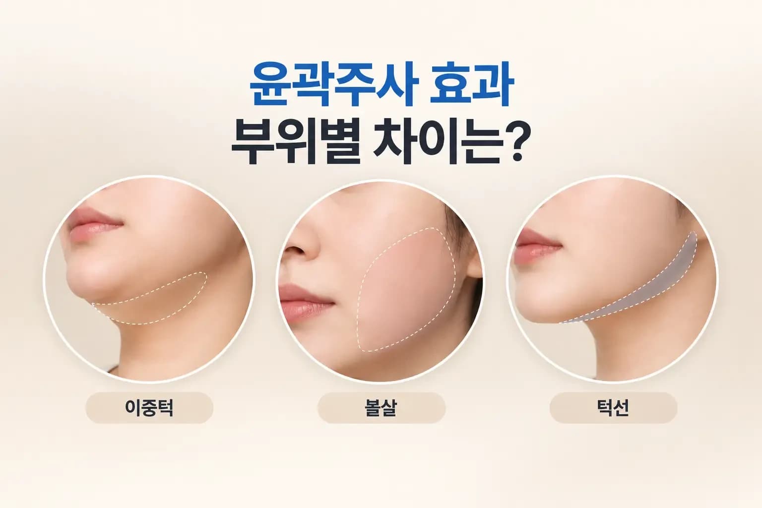 이중턱, 볼살, 턱선 부위를 각각 보여주는 피부 크롭 사진을 나란히 놓은 윤곽주사 효과 썸네일